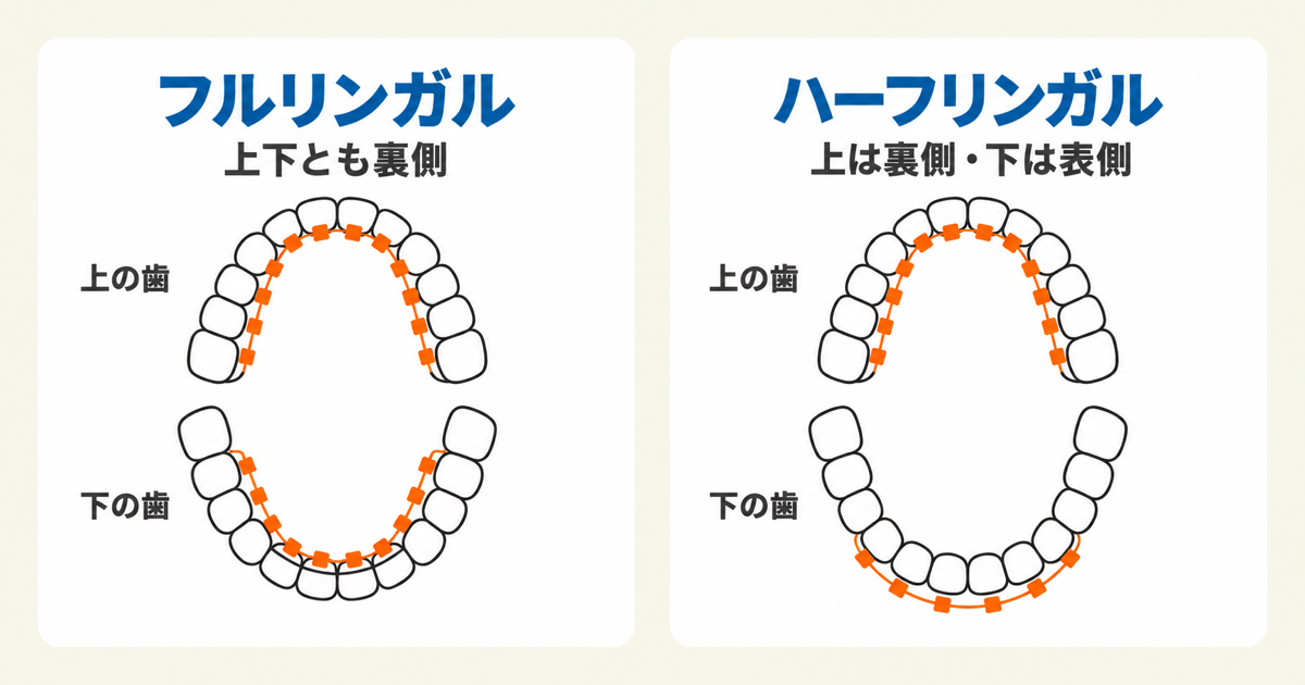 フルリンガルとハーフリンガルの違い(フルリンガルは上下の歯とも裏側に装置、ハーフリンガルは上の歯は裏側・下の歯は表側に装置を付ける歯列の模式図)