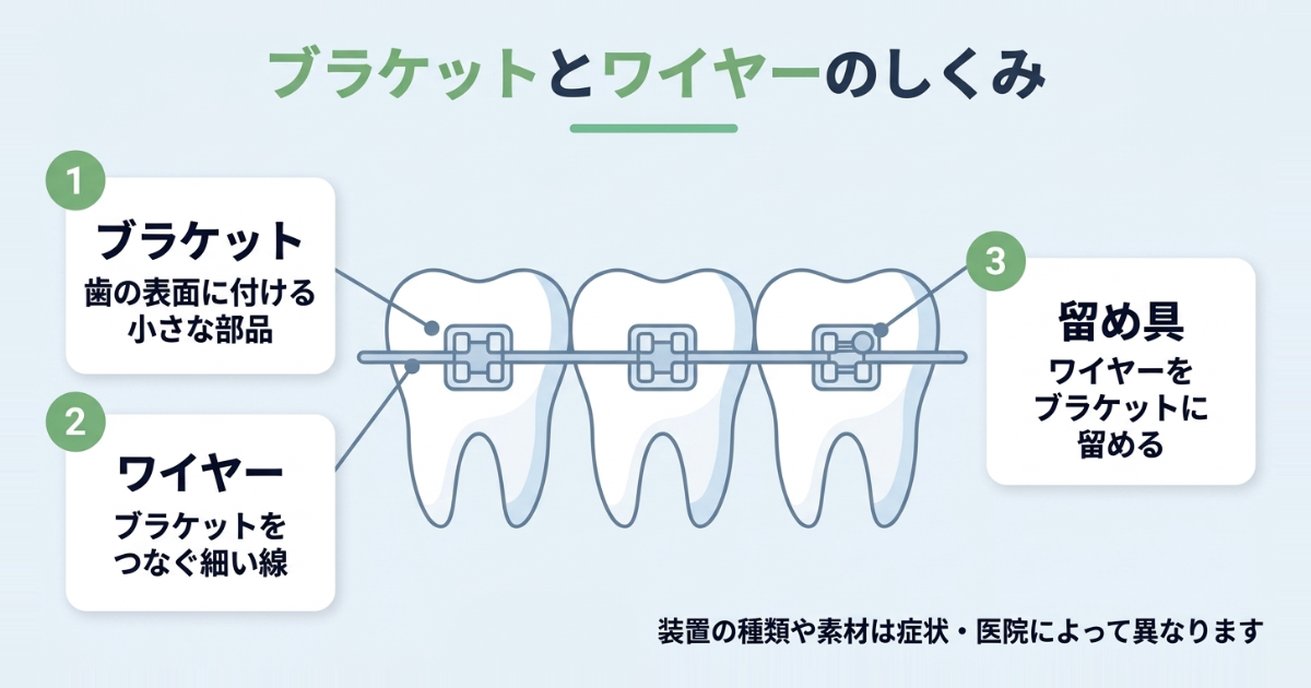 ブラケットとワイヤーのしくみ（ブラケット・ワイヤー・留め具の役割）を示した構造図