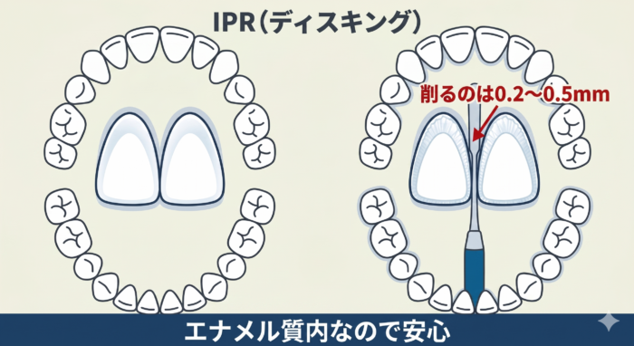 部分矯正で必要な「IPR（周辺エンティティ）」の解説図。歯の表面のエナメル質をわずかに削り、歯を並べるスペースを作るプロセスの視覚化。