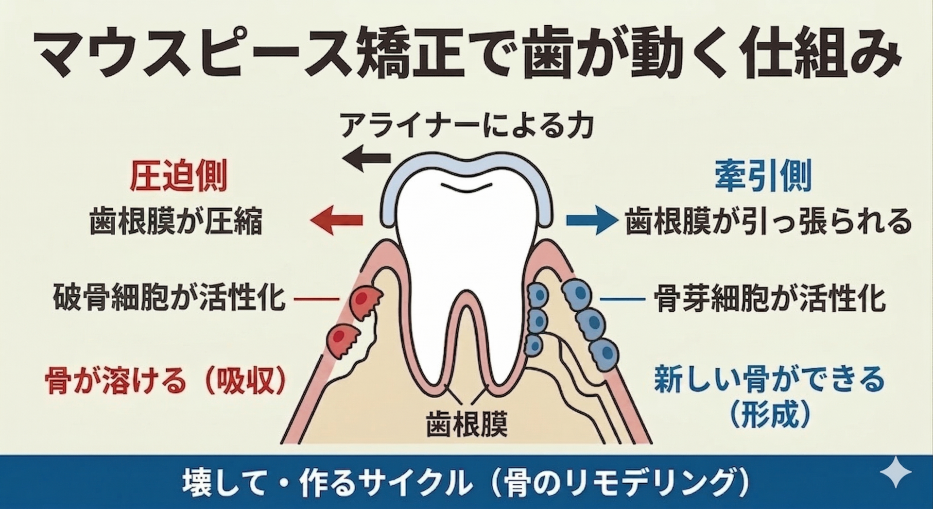 歯の断面模式図を用いて、マウスピース矯正で歯が動く仕組みを解説する図解。アライナーの力によって圧迫された側で破骨細胞が骨を溶かし（吸収）、引っ張られた側で骨芽細胞が新しい骨を作る（形成）という「骨のリモデリング」サイクルを、左右対比で分かりやすく示している。