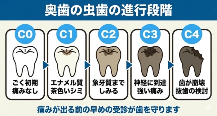 奥歯の虫歯の進行度をC0からC4まで5段階で示した図解。ごく初期の痛みなしの状態から、エナメル質の茶色いシミ、象牙質でしみる段階、神経に達した強い痛み、歯が崩壊して抜歯を検討する段階へと進む流れを描き、痛みが出る前の早めの受診が大切と伝える。
