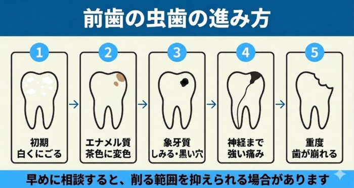 前歯の虫歯の進行段階を左から右へ5段階で示した図解。白くにごる初期から、茶色の変色、黒い穴としみる、神経まで達した痛み、重度で歯が崩れる段階までを並べ、早めに相談すると削る範囲を抑えられる場合があることを伝える。