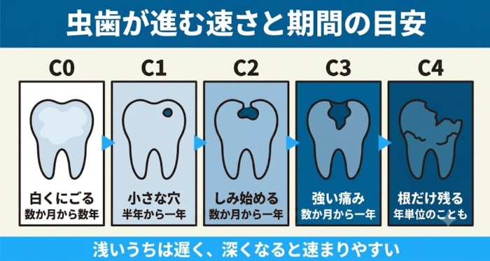 虫歯の進行速度と期間の目安をC0からC4の5段階で示した図解